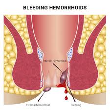 Hemorrhoids: Symptoms, Causes and Treatment
