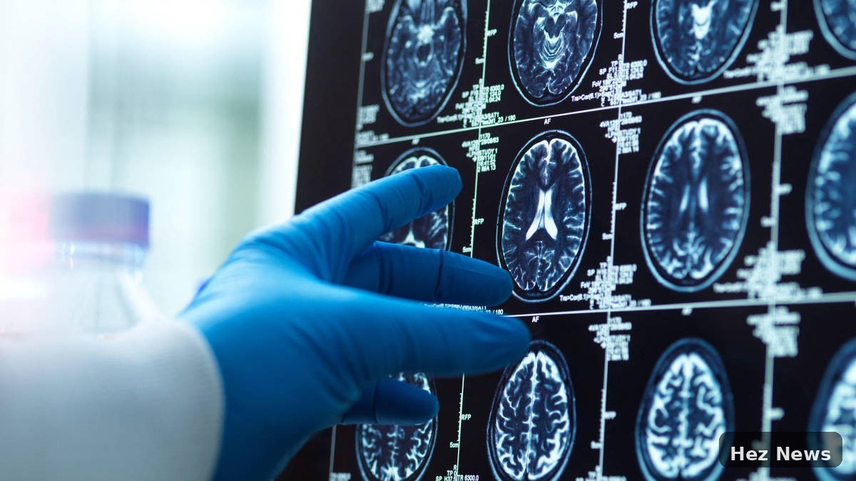 Healthy Adults to Test Drug Aimed at Preventing Alzheimer’s